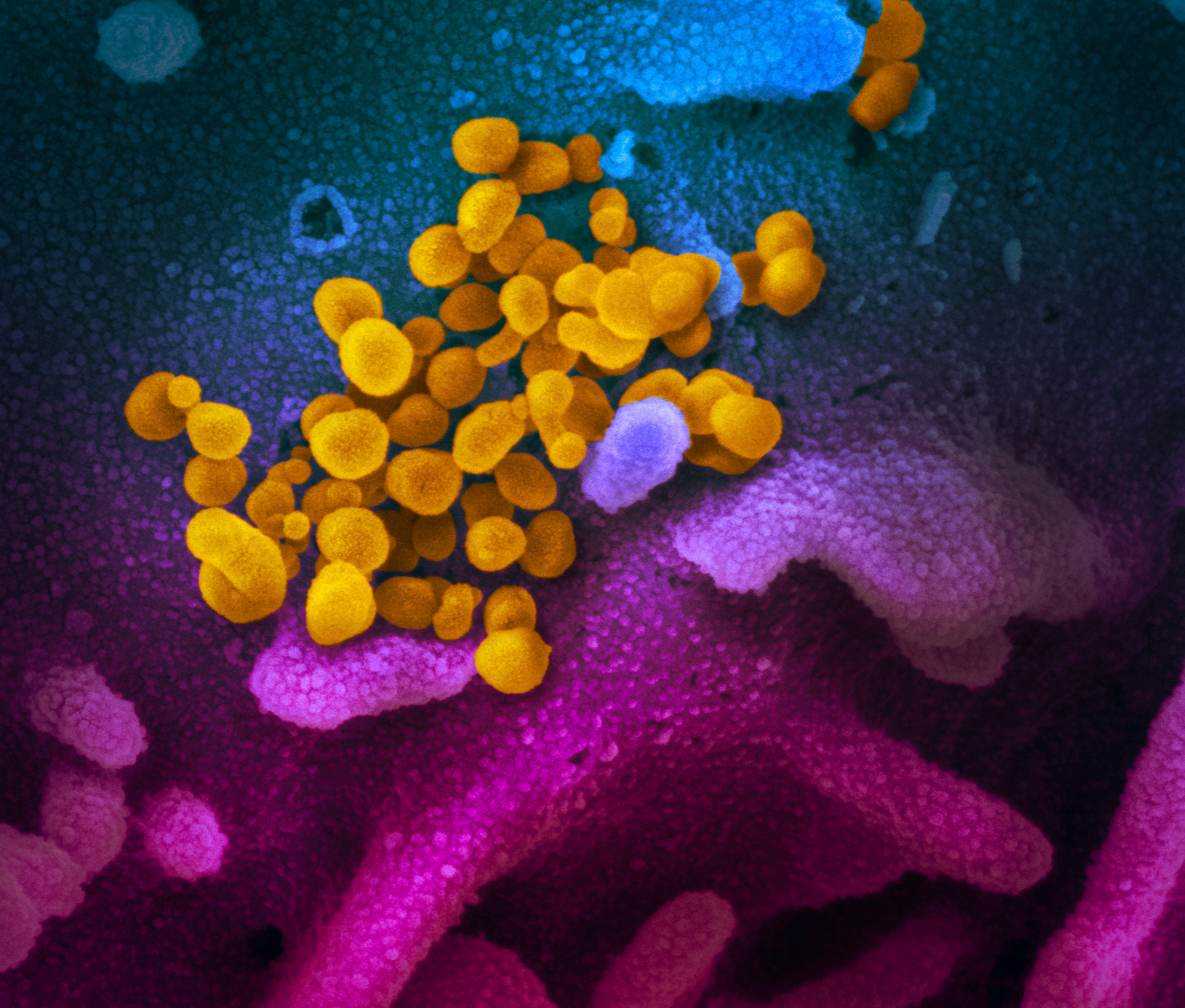Las células rosadas fueron cultivadas en laboratorio, mientras que las amarillas son del coronavirus Covid-19 (NIAID-RML/Handout via REUTERS)