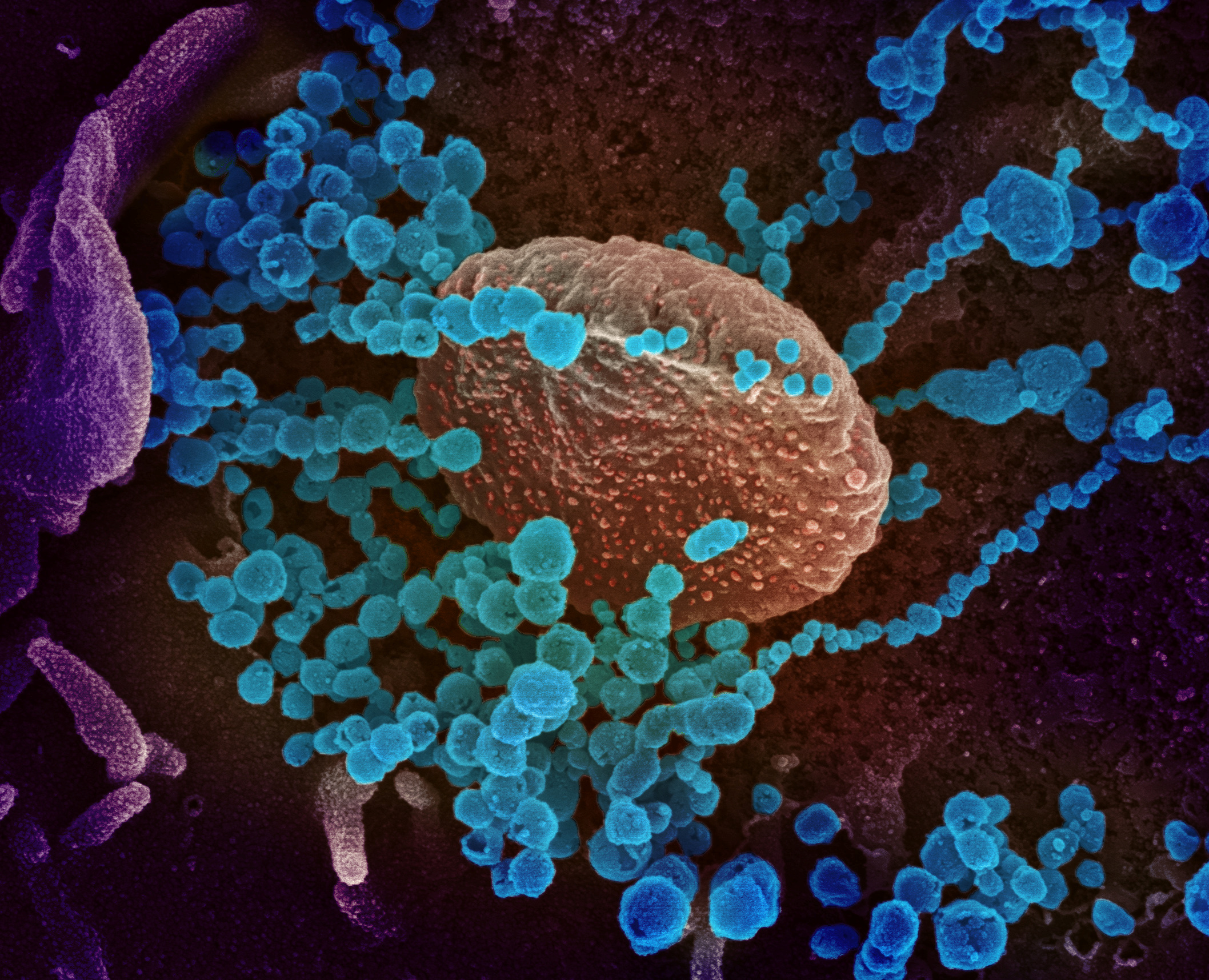Aquí se ve una imagen microscópica aumentada del SARS-CoV-2: una de las cuestiones que provoca el COVID-19 es que la inflamación aumenta la coagulación de la sangre. Y en mayor medida que en otras epidemias. Aparte de todo lo que provoca en el organismo, el coronavirus tendría un efecto mayor de formar coágulos. (REUTERS)