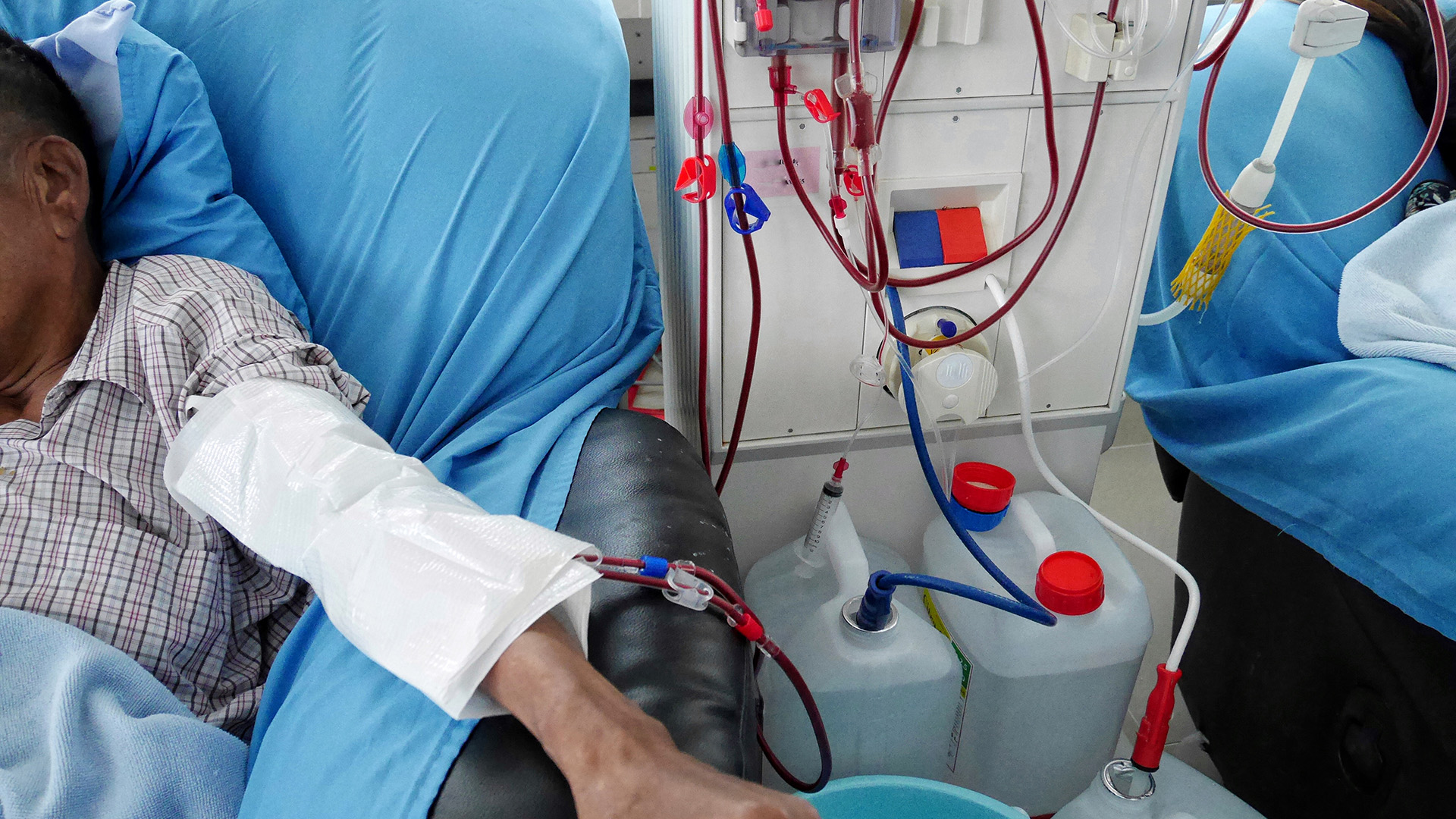 Del mismo modo que hubo escasez de respiradores, en muchos hospitales que atienden pacientes de COVID-19 faltaron máquinas de diálisis, ya que el coronavirus ataca los riñones. (Shutterstock)
