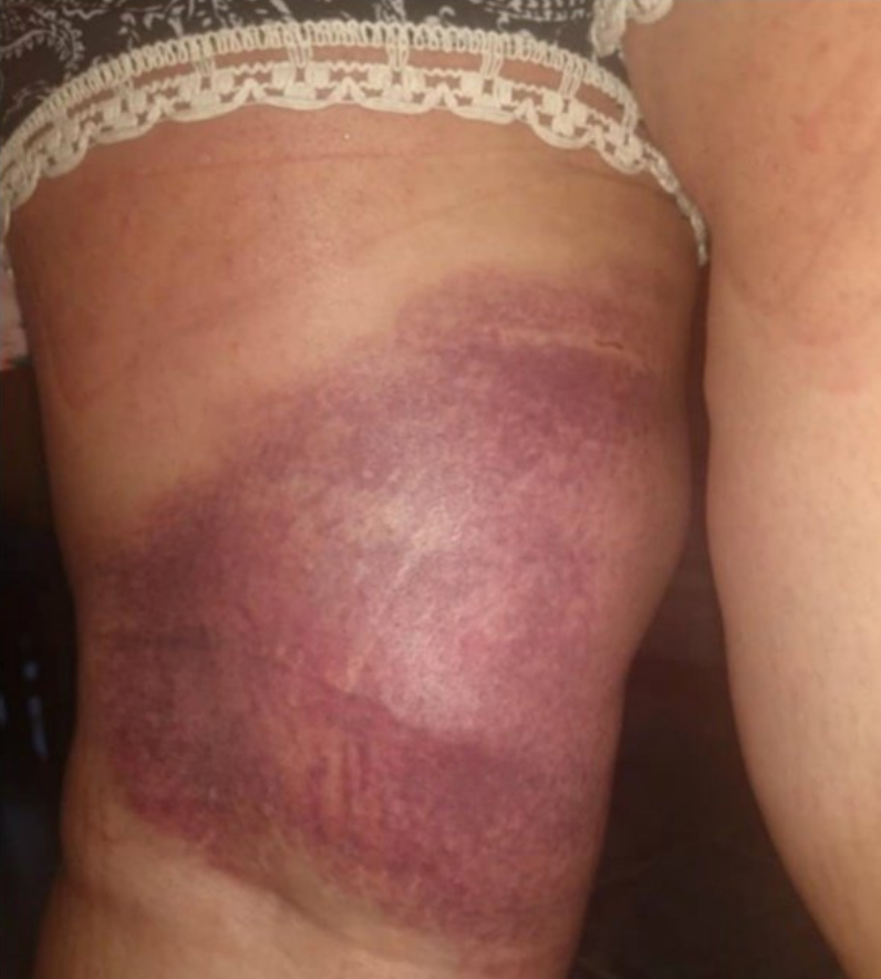 Uno de los hematomas en la pierna de Noelia como consecuencia del accidente