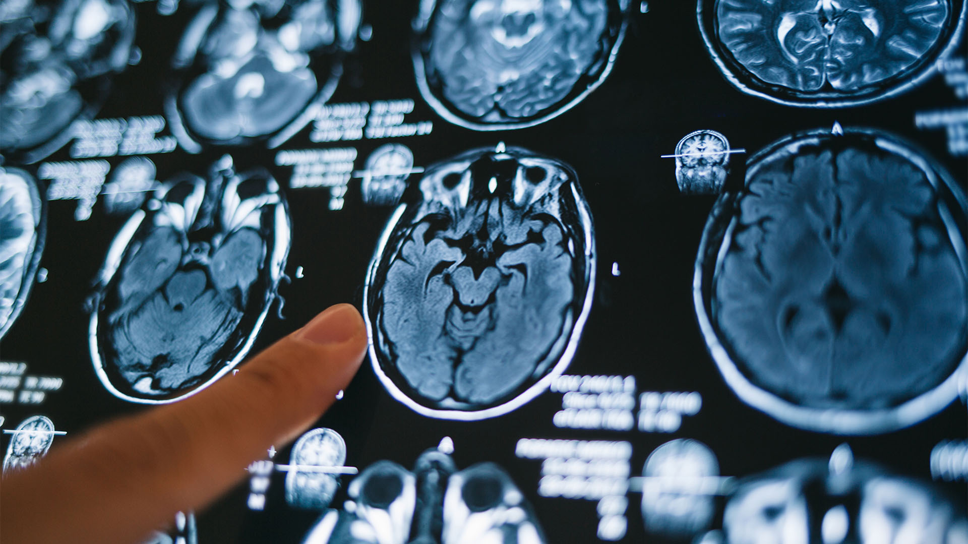 Para esta investigación, los investigadores utilizaron una resonancia magnética con contraste dinámico y modelado cinético para cuantificar las tasas de intercambio específicas en cerebros de roedores anestesiados en posición supina (boca arriba), prono (boca abajo) y lateral (archivo Infobae)