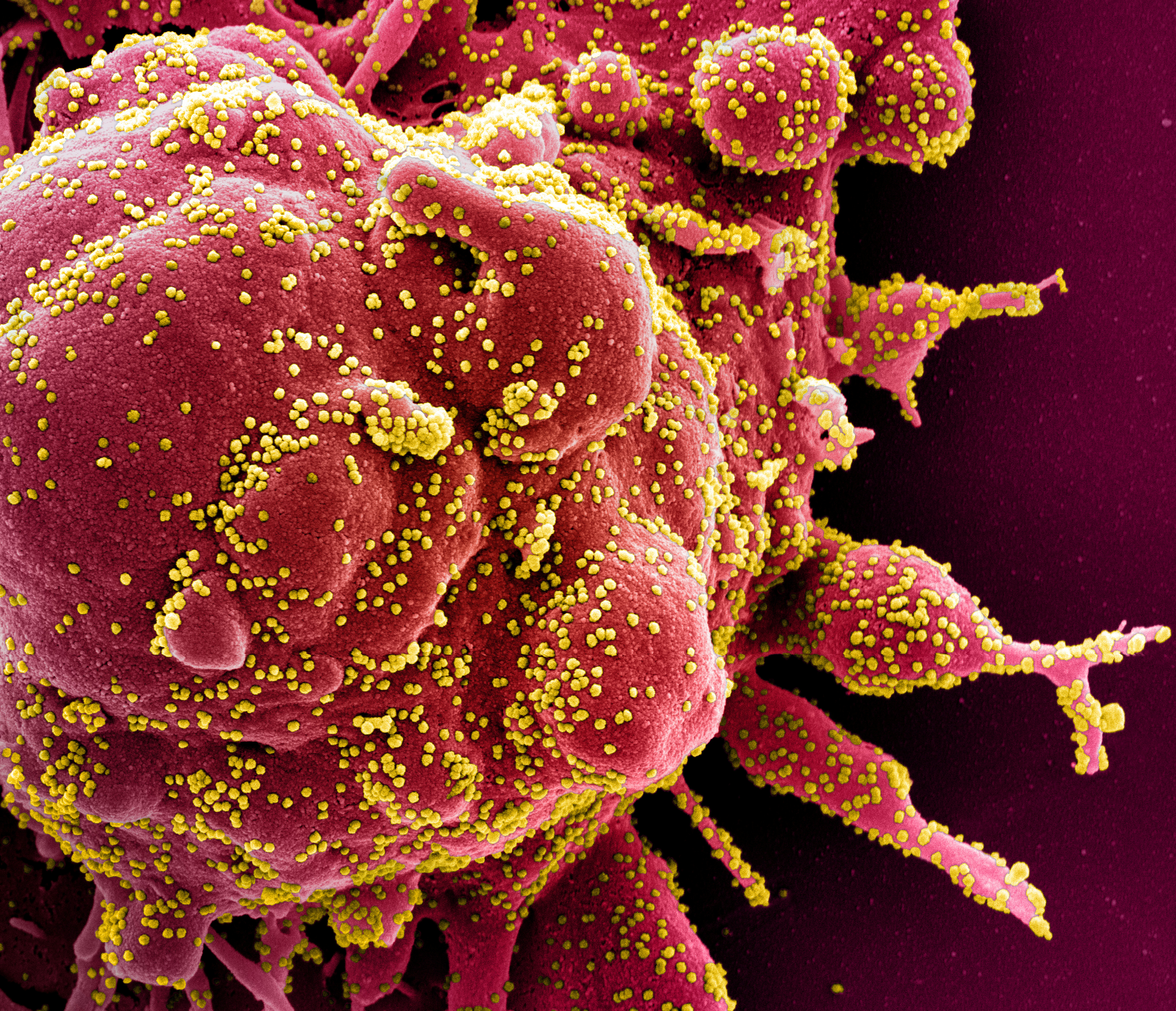 El SARS-COV-2, bajo la vista de un microscopio electrónico - REUTERS