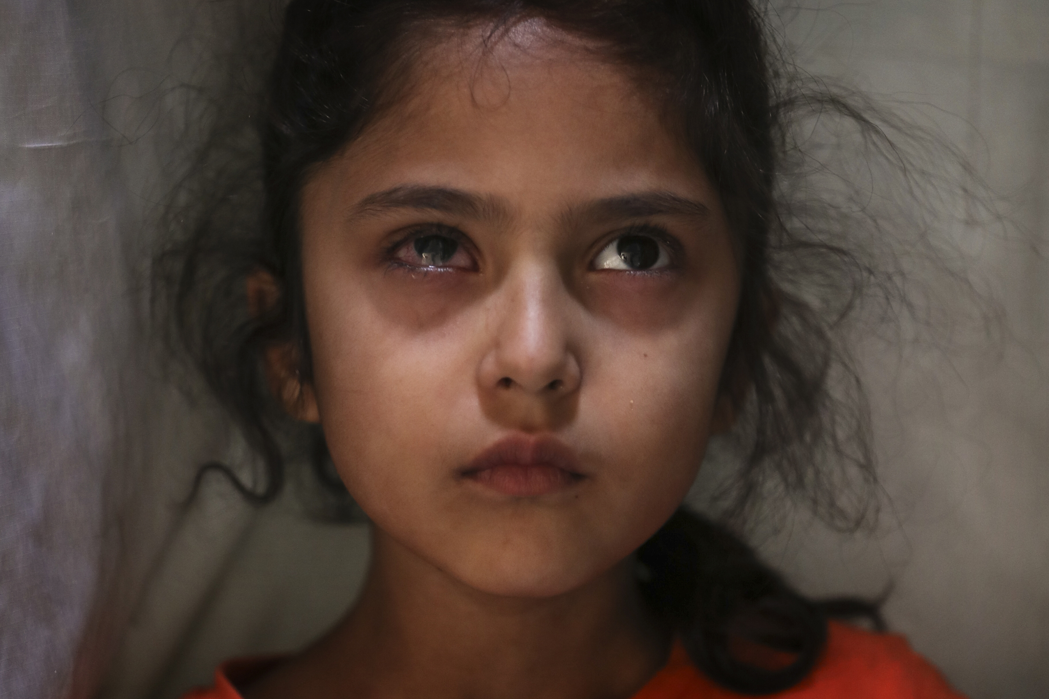 Muneefa Nazir, de seis años, una niña de Cachemira cuyo ojo derecho fue golpeado por una bola de mármol disparada supuestamente por soldados paramilitares indios el 12 de agosto, se encuentra frente a su casa en Srinagar, Cachemira. (Foto AP / Mukhtar Khan)