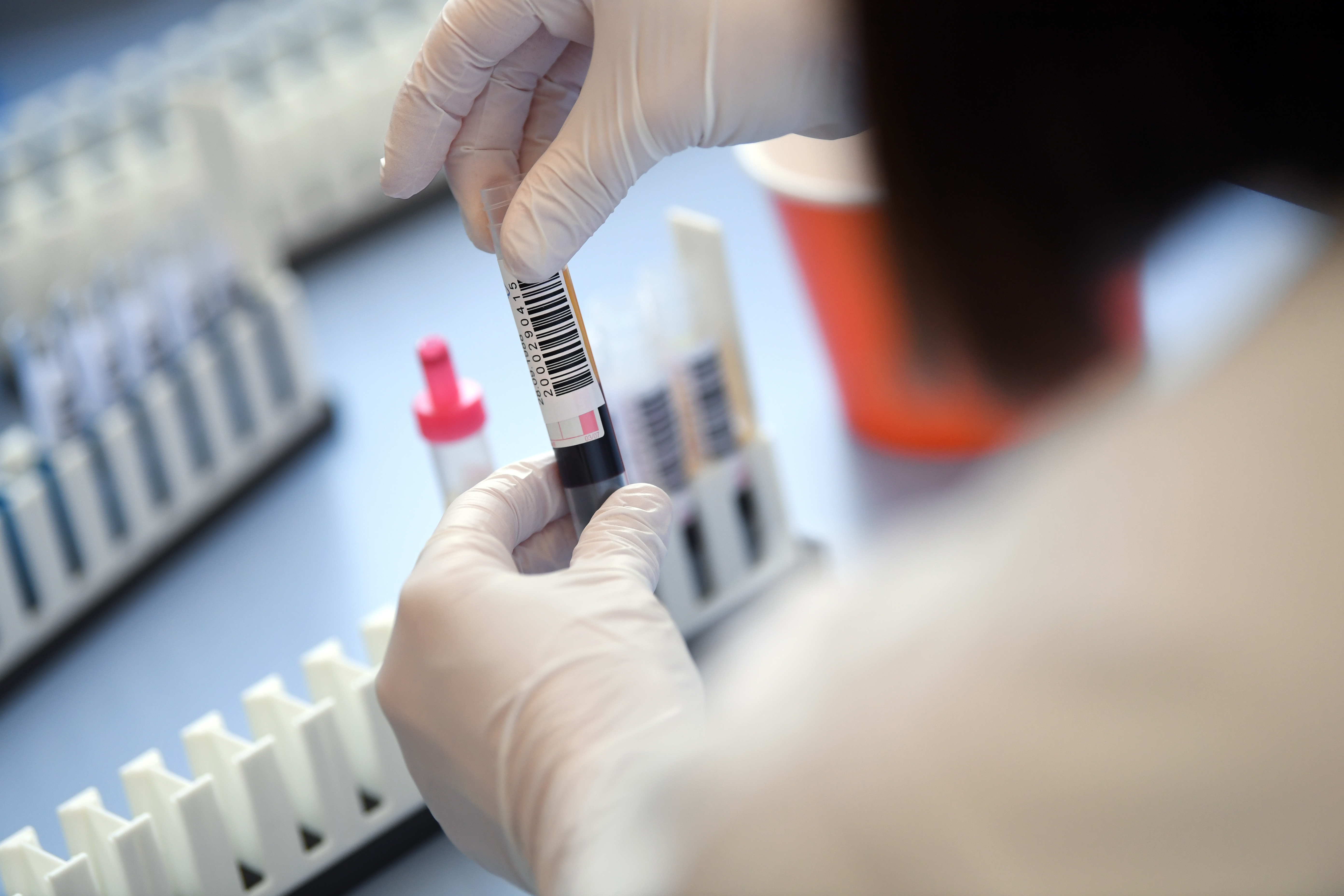 Las personas recuperadas de COVID-19 poseen en el plasma de su sangre los anticuerpos que podrían beneficiar a quienes están cursando la enfermedad (Foto: REUTERS)